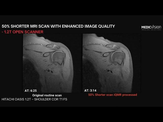 Enhance low-field MRI scanners: cut scan time by 50% while maintaining image quality