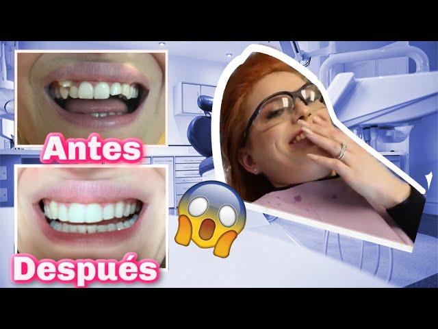 Me Quitan Los Brackets  | Increíbles resultados 