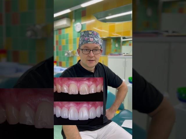 Сильно ли обтачиваются зубы перед реставрацией?
