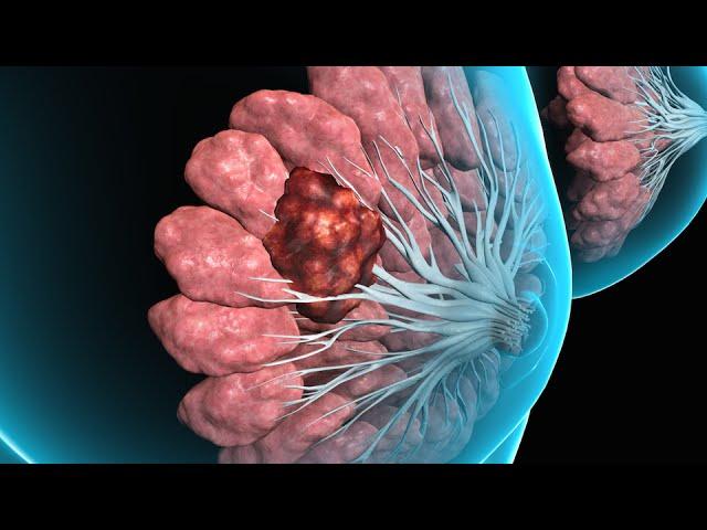 Breast Tissue Biopsy (2008)