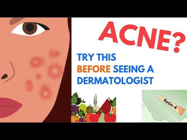 ACNE Treatments | Explained by Dermatologist