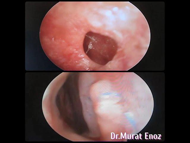 Nasal Septum Perforation Surgery - Before and 1 Month After  -Nazal Septum Perforasyonu Ameliyatı