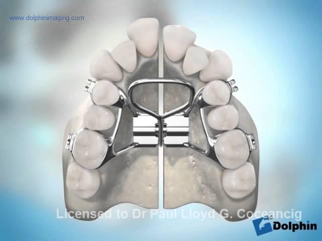 Surgically Assisted Palatal Expansion