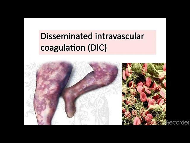 Disseminated intravascular coagulation ( DIC) ,made easy