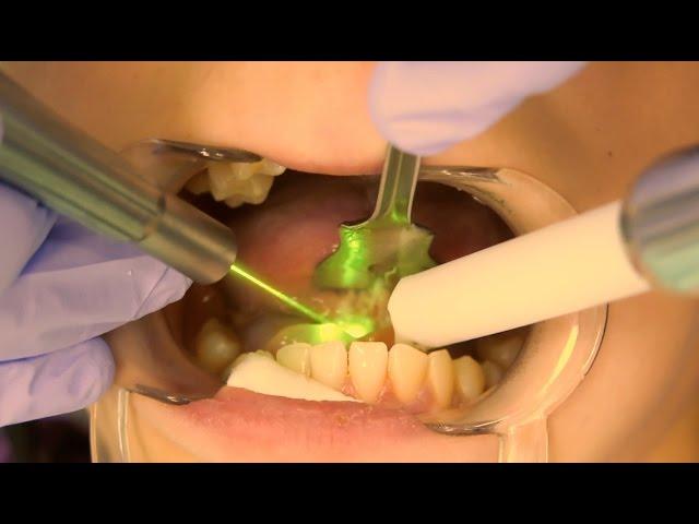 Tongue-Tie Laser Surgery by Dr. Jason Tubo