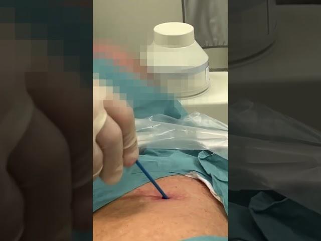 Ultrasound guided pericardiocentesis