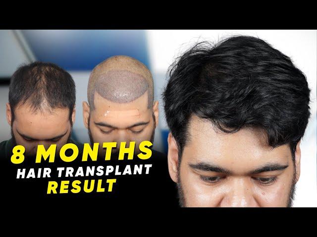 Hair Transplant in Russia | Best Results & Cost of Hair Transplant in Russia