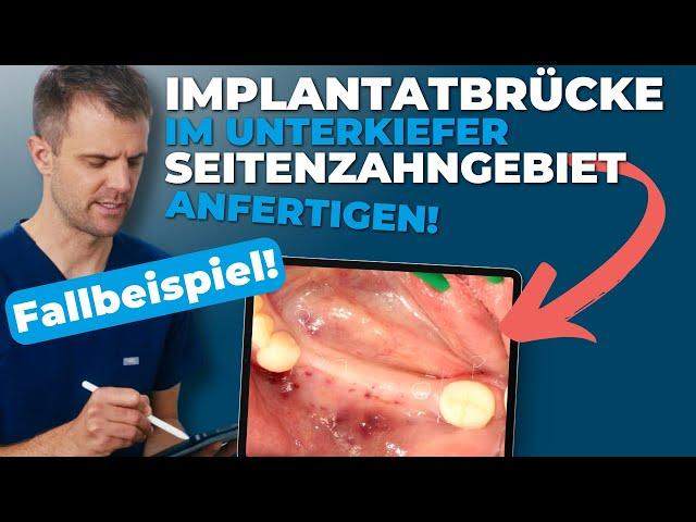 Implantatbrücke im Unterkiefer Seitenzahngebiet | Fallbeispiel