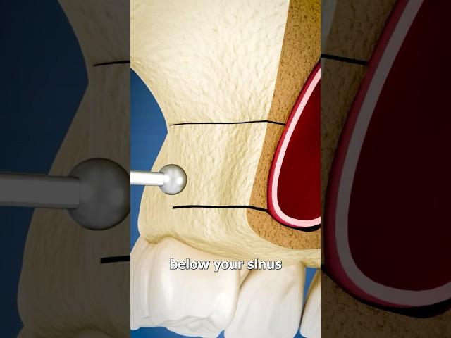 Sinus Lift Surgery Explained  Surgeon Reacts