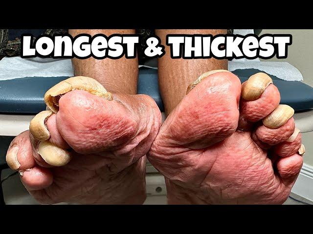 LONGEST & THICKEST TOENAILS EVER! 