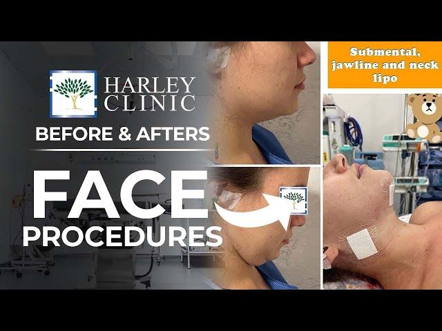 Plastic Surgery Face Procedure Before & Afters - Face, Neck & Eyebrow Lifts | Harley Clinic (Vol 2)