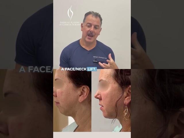 Chin Implants: Profile Enhancement #cosmeticsurgeons #chinimplant #medicaleducation