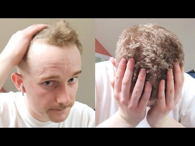 THIS Keeps ALL MEN Insecure Over Hair Loss (& How to STOP)