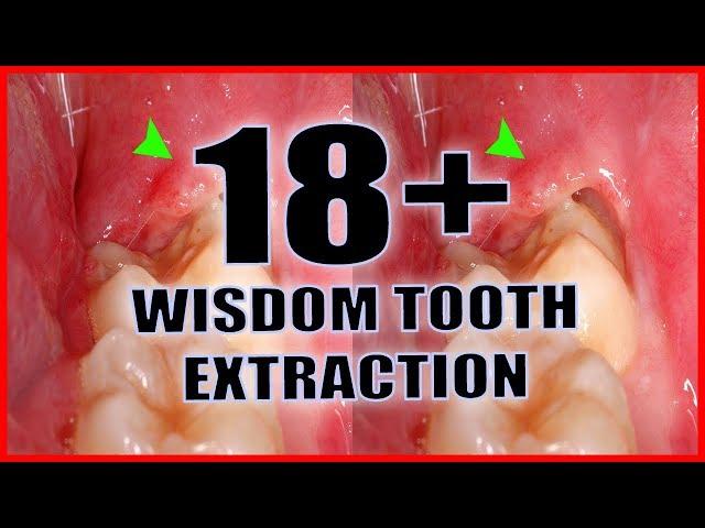 WISDOM TOOTH EXTRACTION!! +18 !!