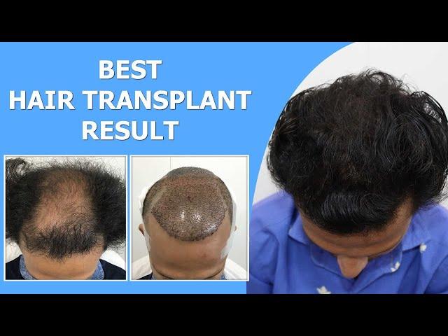 Best Hair Transplant Result || 4000+ Grafts || NW-5 Grade Baldness || Hairfree Hairgrow Clinic Surat