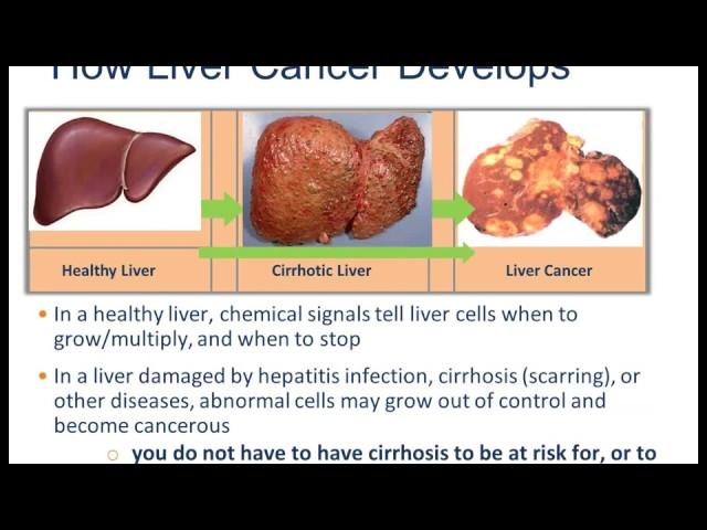 TREATMENT OPTIONS FOR LIVER CANCER by Dr. Robert Gish