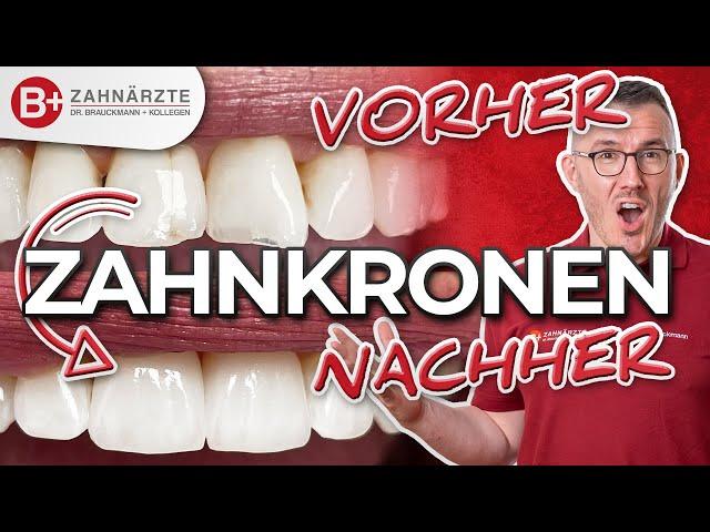 Zahnkronen Vorher-Nachher: Wie wird es gemacht bei Frontzähnen? Ablauf erklärt am Patienten Fall!