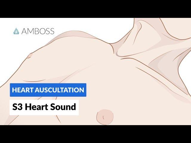 S3 Heart Sound (S3 Gallop) - Heart Auscultation - Episode 9