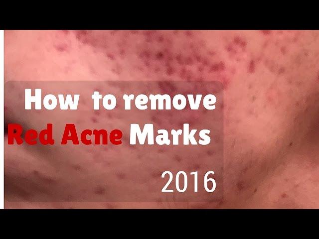 How to remove red marks from acne