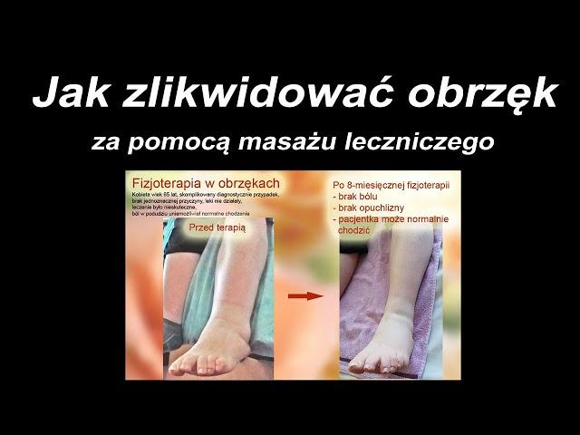 Jak zlikwidować obrzęk za pomocą masażu leczniczego?