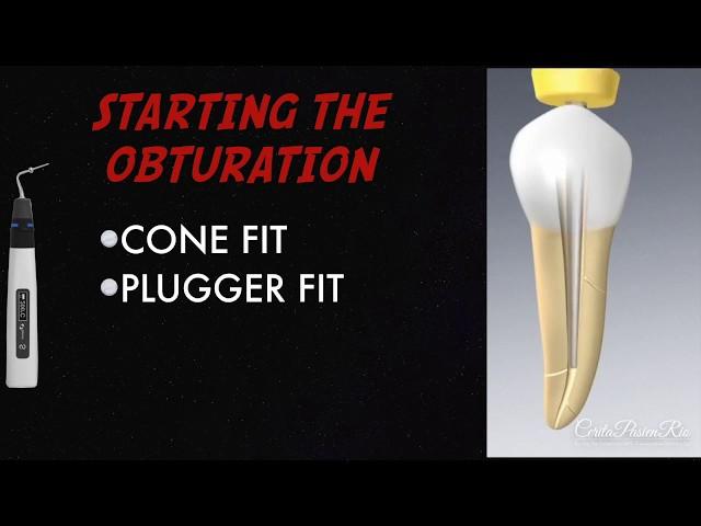 warm vertical compaction endodontic continuous wave obturation Fast-Fill Fast-Pack from Eighteeth