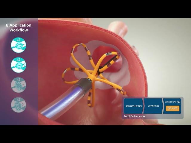 FARAPULSE™ Pulsed Field Ablation System Animation