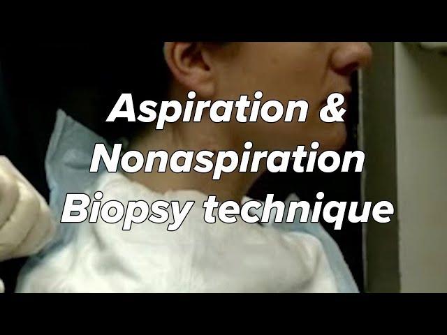 Aspiration & Nonaspiration (Zajdela) technique - Biopsy, Fine Needle, Neck Mass