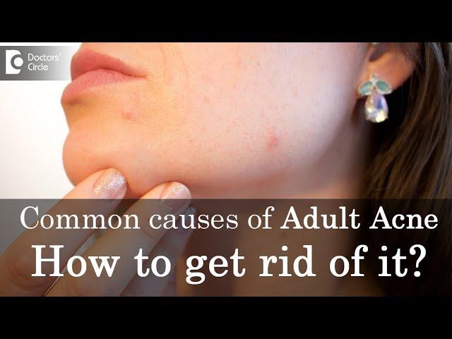 Common causes of Adult Acne and How to get rid of it? - Dr. Rasya Dixit