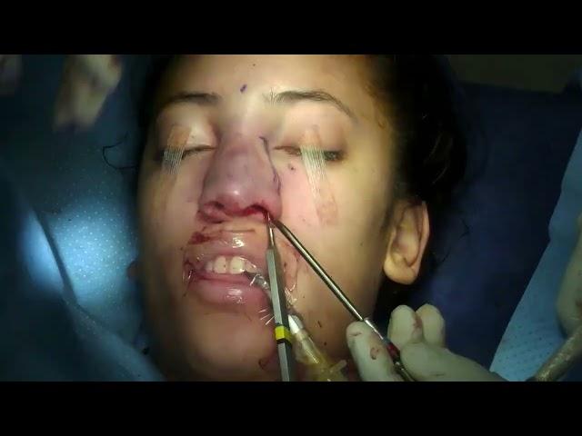 Open Rhinoplasty: Watch Entire Surgery Time Lapse!