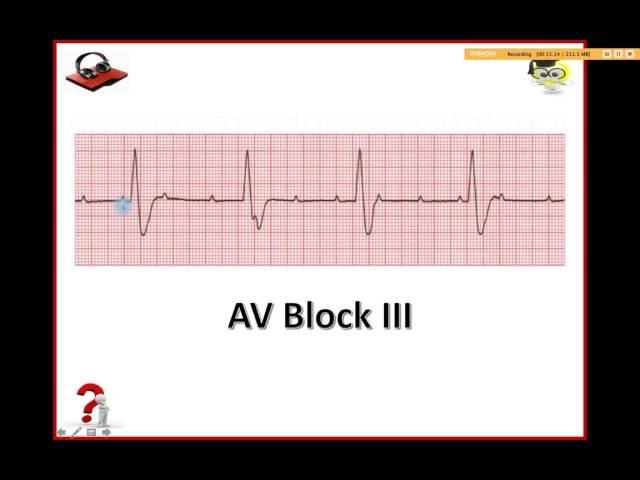 Ekg Podcast 25 of 59. AV Blokády. 2. Časť