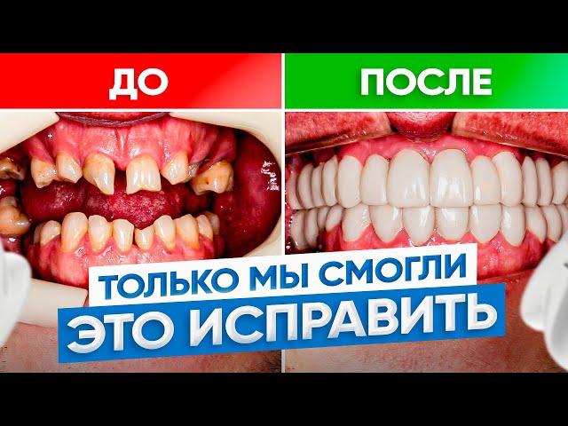 Их взяли только мы! Очень кривые зубы – ДО/ПОСЛЕ. Исправление прикуса брекетами