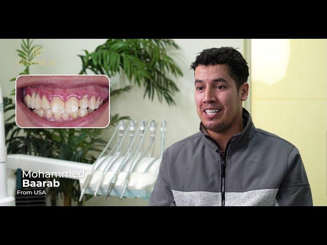 Overbite case treated with Zirconia Crowns  made his smile return [by Dentakay in Turkey]