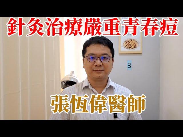 五臟平衡針法臨床實戰  青春痘的針灸治療