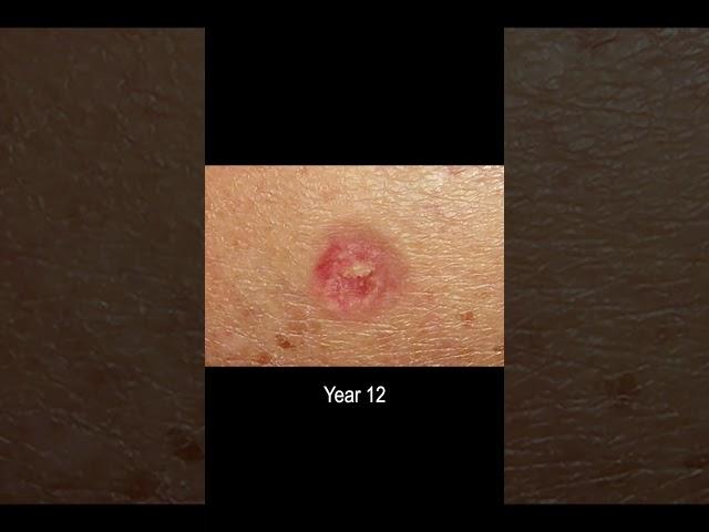 Basal Cell Carcinoma Skin Cancer Development Time Lapse (Normal to Cancer Over 25 Years)