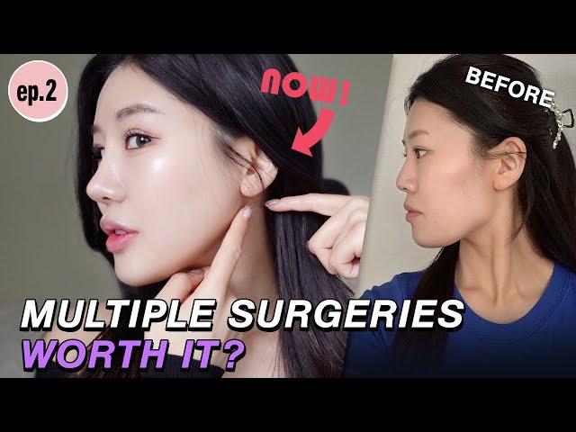 [SUB]Ep.2: New Update on a 6-month Post Surgery of Multiple Procedures here at Nana Plastic Surgery!