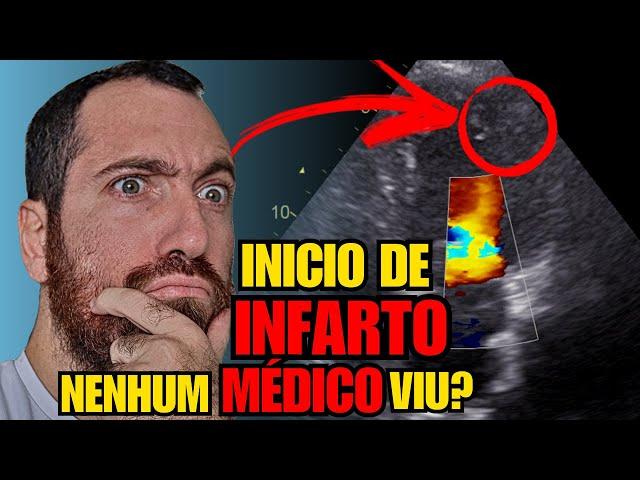 SINAIS DE INFARTO podem começar ANTES DOS SINTOMAS DE INFARTO! Veja um MIOCÁRCDIO no ECOCARDIOGRAMA