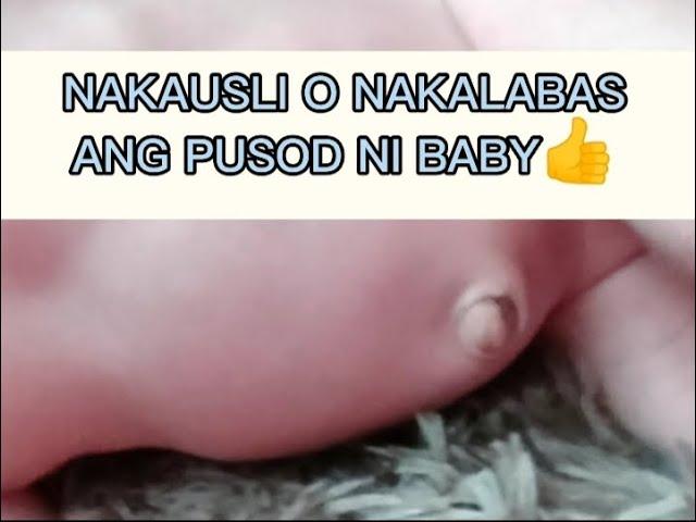 Nakausli o nakalabas na pusod ni baby