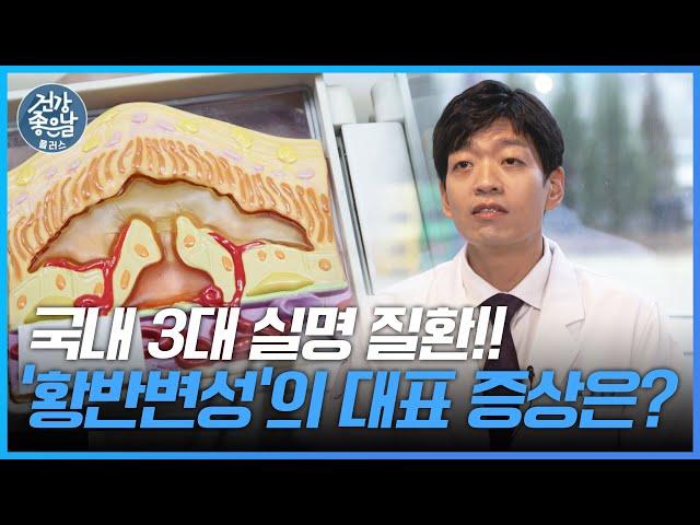 치료시기를 놓치면 실명 물체가 휘어져 보인다면 '황반변성'을 의심하세요! [#건강좋은날플러스 ep.56]｜MBC경남 230405 방송