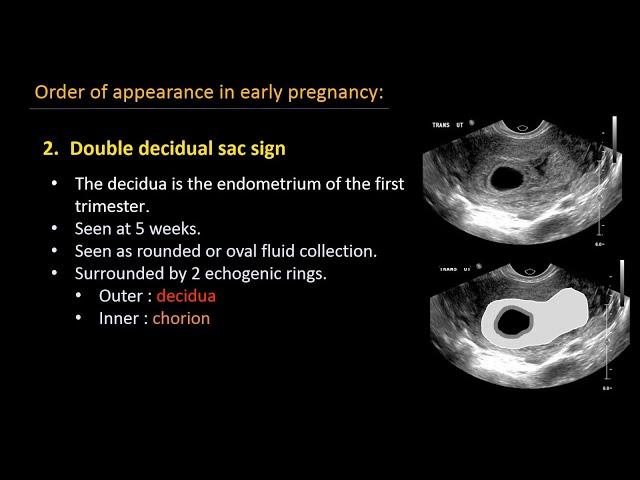 Ultrasound of normal early pregnancy