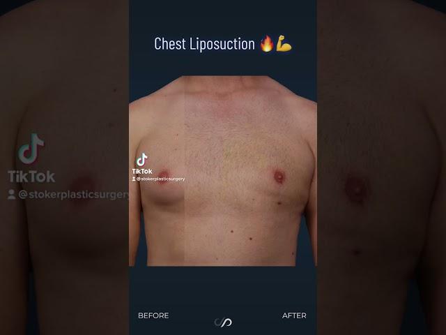 Male Chest Contouring Using Liposuction | Los Angeles, CA.