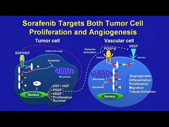 Hepatocellular Carcinoma - Molecular Approaches to Treatment