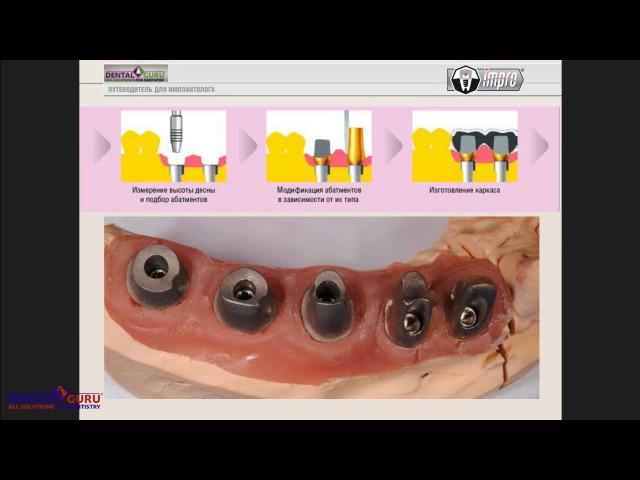 2017 06 27  Особенности выбора абатмента.  Цементная фиксация vs Винтовая.