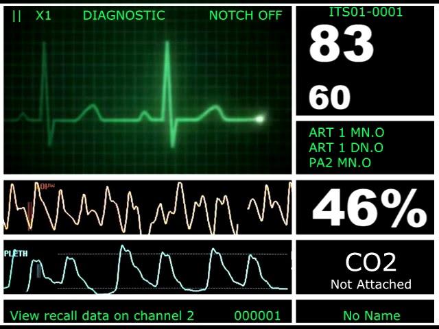 Hospital Monitor with FlatLine (M) (SD)