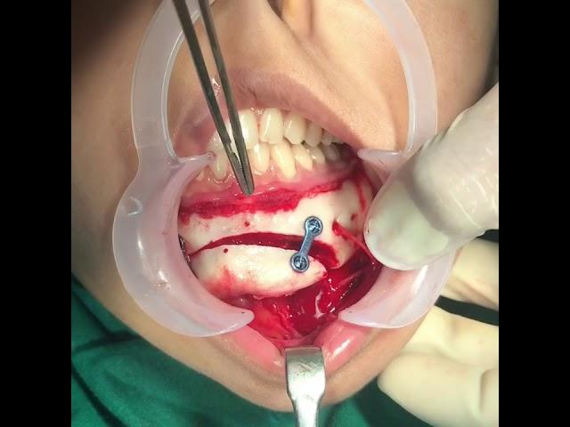 Genioplasty or asymmetric mentoplasty by Dr RICHARDSON in south india