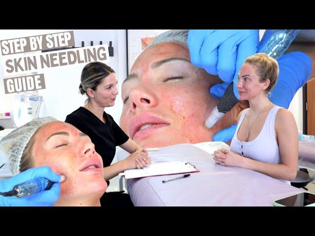 7 Step Skin Needling Treatment | Step By Step Procedure Performance Tutorial | Level 4 VTCT Course