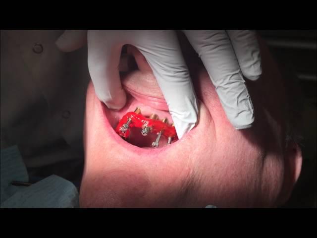 #allonx #allon4 Step-by-Step All-on-Four Dentures: Part 1: Impressions