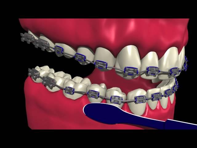 How to Brush and Floss with Braces - Marda Loop Braces - Dr. Andrew Chen