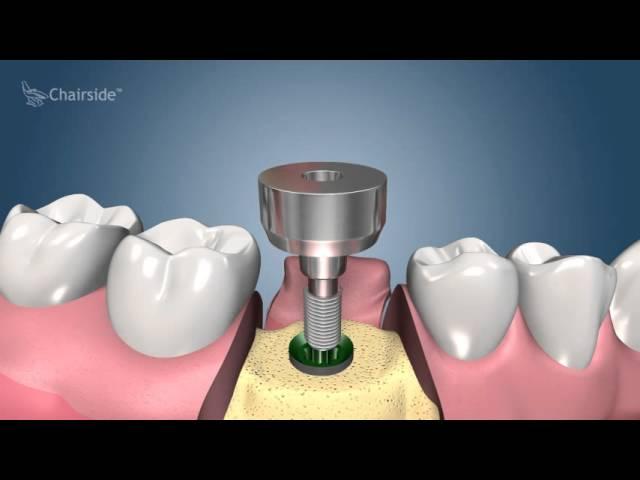 Dental Implant Procedure - Two Stage    Award Winning Patient Education