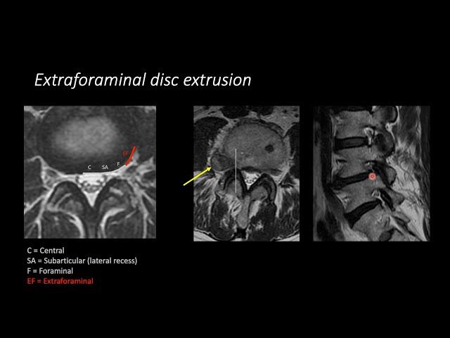 Lumbar Spine MRI by Eric Tranvinh, MD, Stanford Radiology