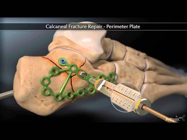 Calcaneal Fracture Perimeter Plate